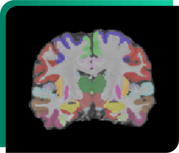 Alzheimer -Longitudinal - Volumetric