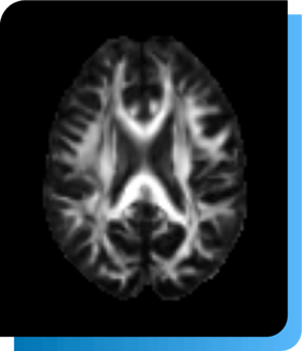 Alzheimer -White matter integrity by diffusion tensor imaging