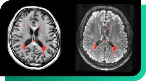 MultipleS- Automated Lesion Delineation