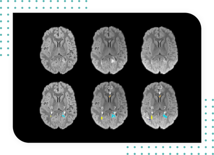 MultipleS- Changes in Lesion Count and Lesion Volume