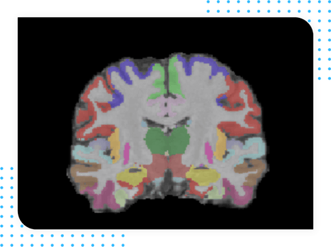 MultipleS-Changes in Brain Volume as detected by brain MRI