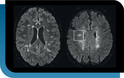 MultipleS-Detection of Central Vein lesions