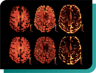 MultipleS-Diffusion Measures Around Lesions
