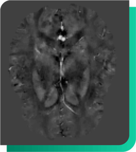 MultipleS-Quantitative Susceptibility Mapping