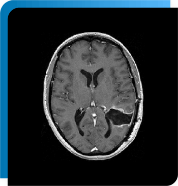 MultipleS-T1 weighted gadolinium enhanced lesion