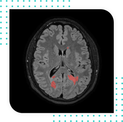 MultipleS-T2 weighted lesion detection