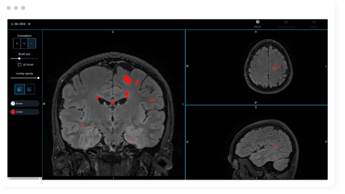 Multiple Sclerosis MS Imaging