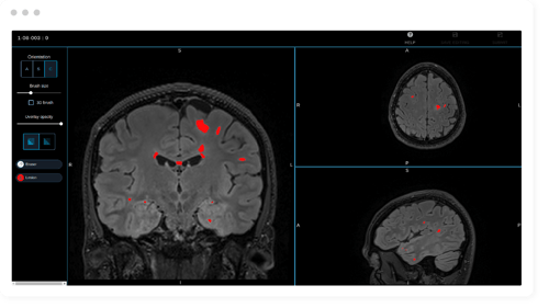 Multiple Sclerosis MS Imaging Multiple Sclerosis MS Imaging