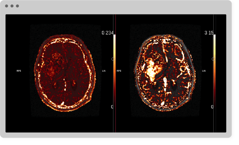 Neuro Oncology Neuro Oncology