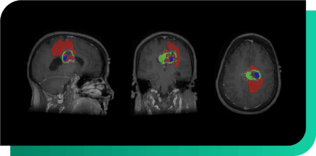 Oncology - Brain Tumor Volume Quantification-