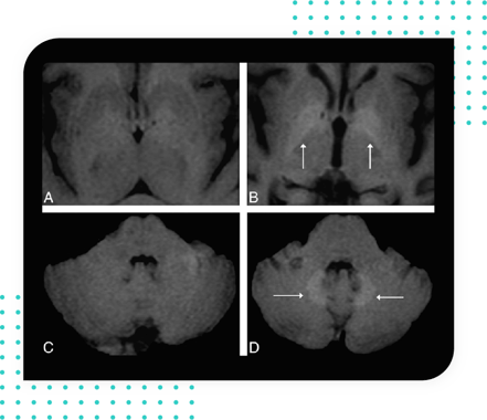 Oncology - Gadolinium deposition-