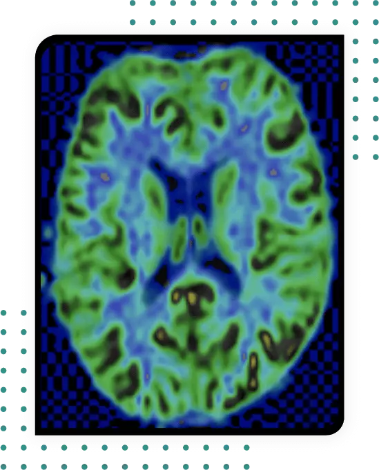 Alzheimer - Arterial Spin Labeling MRI
