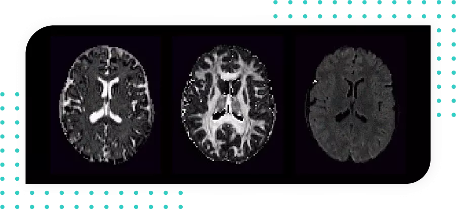 Alzheimer - MRI white matter free 