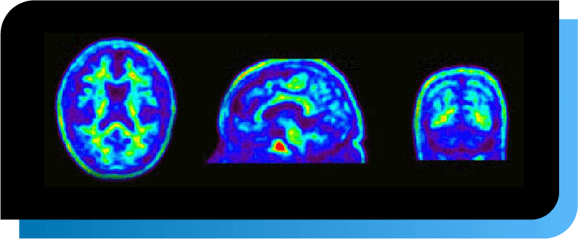 Alzheimer -Amyloid PET