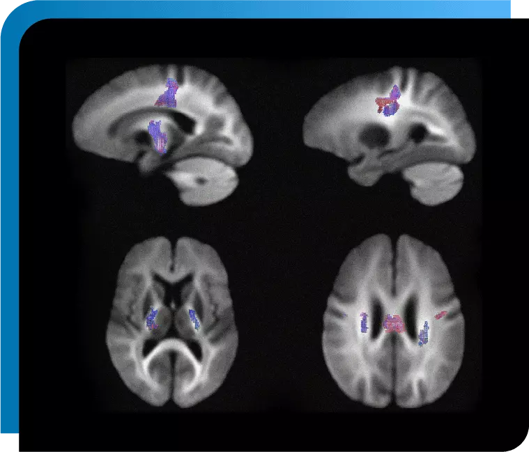 Alzheimer -Change in MRI Apparent Fiber Density