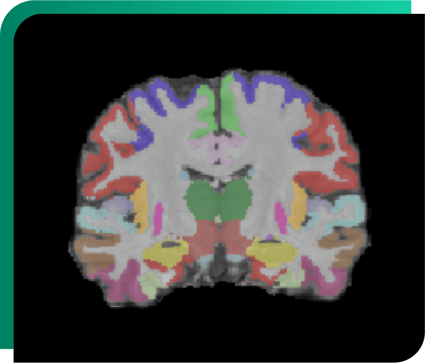 Alzheimer -Longitudinal - Volumetric