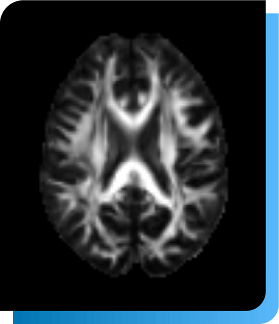 Alzheimer -White matter integrity by diffusion tensor imaging