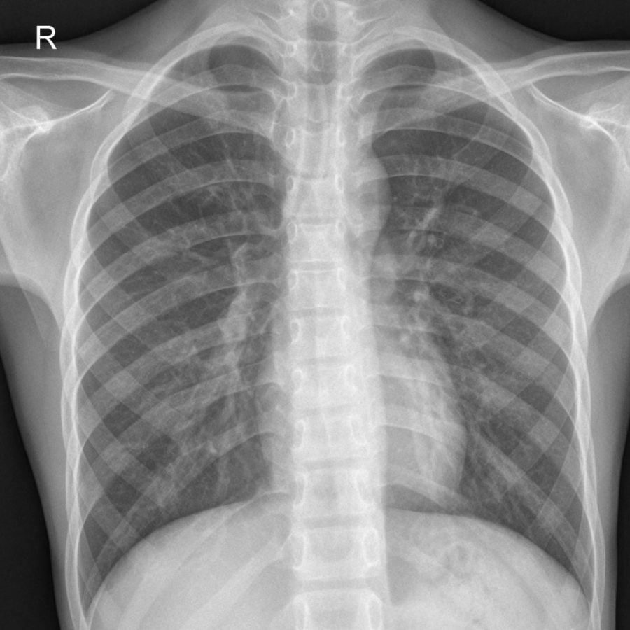 chest x ray pneumonia