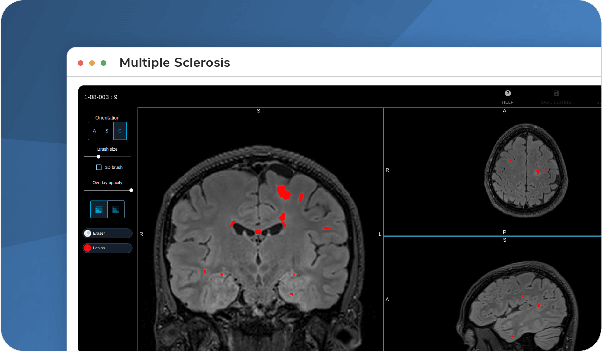 Multiple-Sclerosis-pack