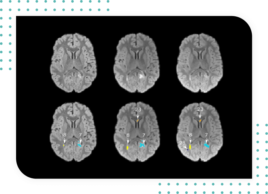 MultipleS- Changes in Lesion Count and Lesion Volume