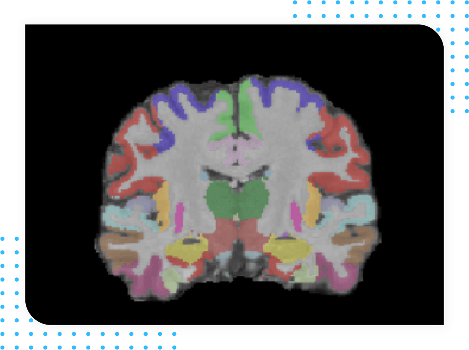 MultipleS-Changes in Brain Volume as detected by brain MRI