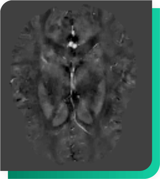 MultipleS-Quantitative Susceptibility Mapping