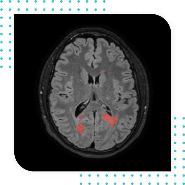 MultipleS-T2 weighted lesion detection