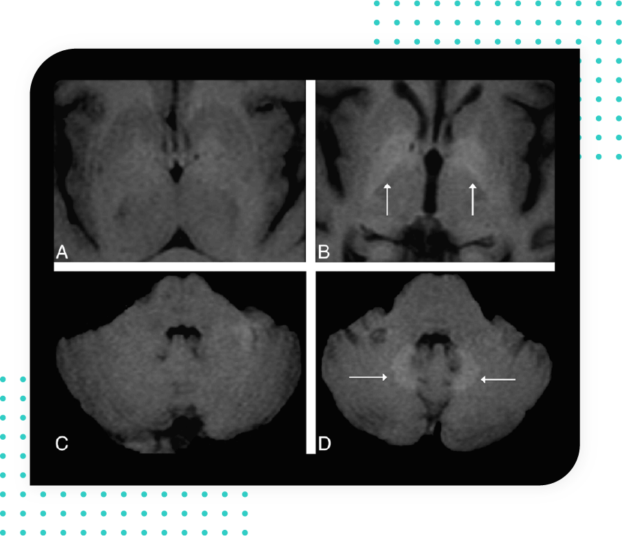 Oncology - Gadolinium deposition-
